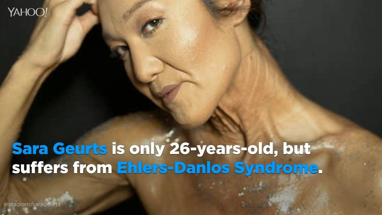 305K views · 550 reactions | Model Sara Geurts, 26, is owning the "wrinkles" she has from a rare condition and challenging traditional beauty standards: | Yahoo