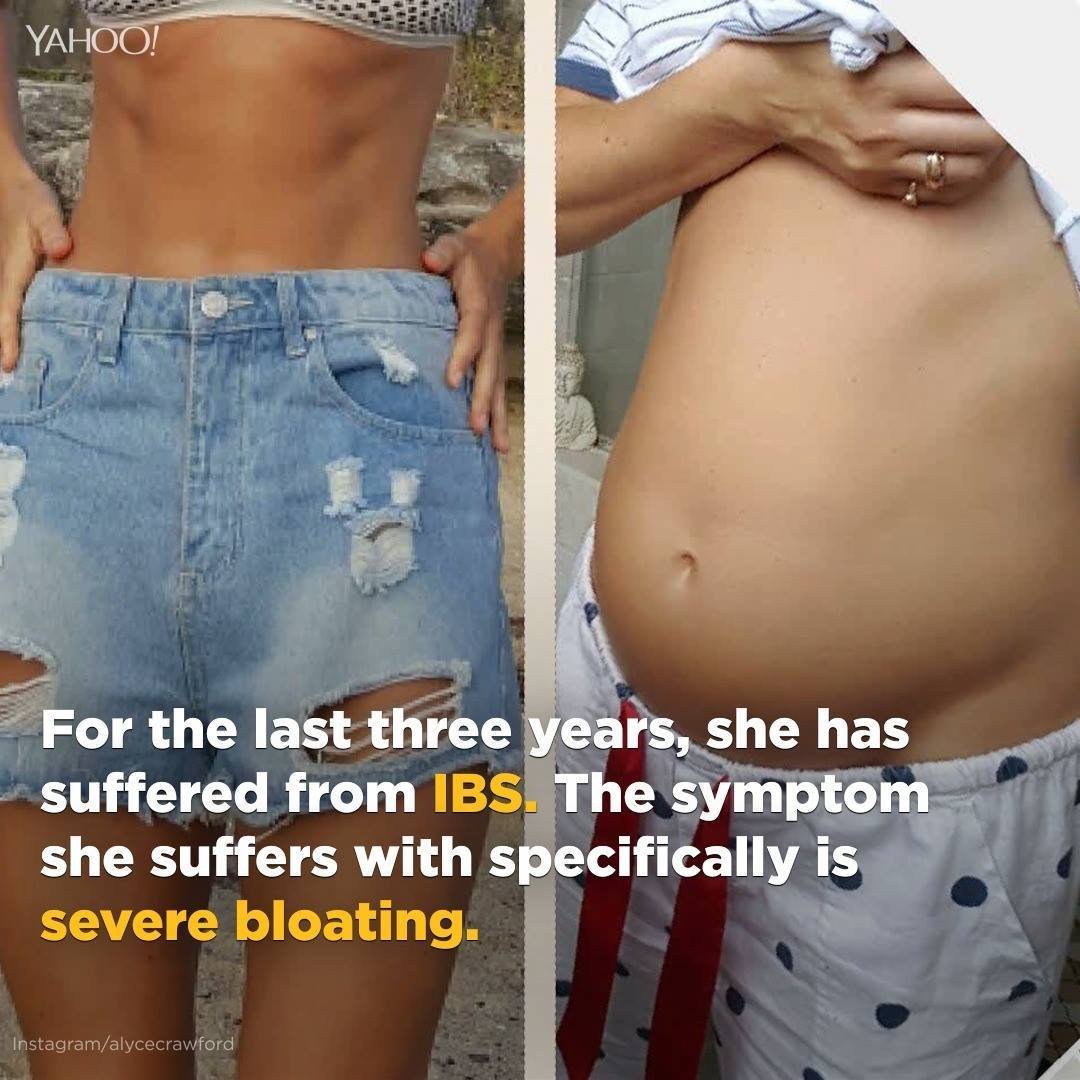 586K views · 198 reactions | For the last three years, model Alyce Crawford has suffered from IBS. She's just gotten real about it on Instagram. | Yahoo