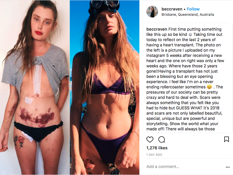 203K views · 314 reactions | A 29-year-old model shows off her heart transplant scars on Instagram. (via Yahoo Canada) | Yahoo News